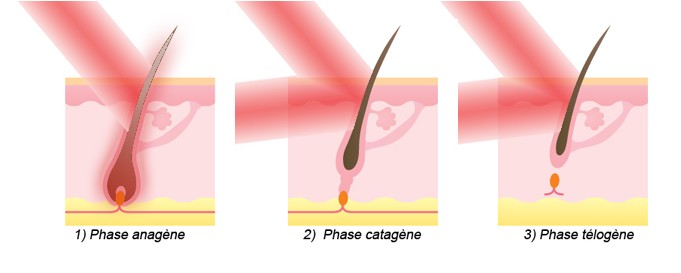 epilateur laser principe